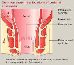 The opening of the channel at the skin (external) generally appears as a red, inflamed area that may ooze pus and blood. Benign Anorectal Conditions Perianal Abscess Fistula In Ano Haemorrhoids Fissures And Pilonidal Sinus Sciencedirect