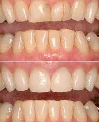 Get the fastest access to the best doctors. Cosmetic Dentistry Crooked Teeth Near Me Dental News Network