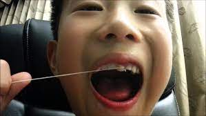 See full list on wikihow.com Funniest Ways To Pull Out Children S Loose Teeth Town Center Dentistry