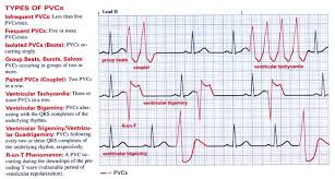 In the recently updated american heart association (aha) practice standards for ecg monitoring in hospital setting, recommendation for pvc monitoring. Premature Ventricular Contractions Cardio Cardiovascular World Facebook