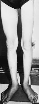 Poliomyelitis-like illness due to Japanese encephalitis virus