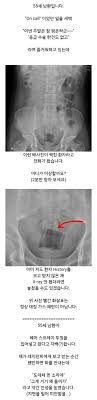 항문에 자꾸 뭘 넣는 남자들 때문에 고통받는 응급실 의사분들ㅋㅋㅋㅋ - 악플달면 쩌리쩌려버려 - ＊여성시대＊ 차분한 20대들의 알흠다운  공간