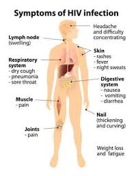 Image result for AIDS-Defining Illness