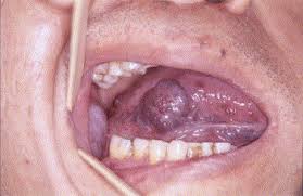The Blue Rubber Bleb Nevus Syndrome A Case With Prominent Head And Neck Findings Sciencedirect