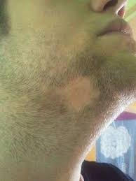 It is a severe condition; Alopecia Areata Baldness And Hair Loss Causes Symptoms And Treatment Patient