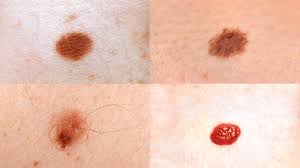 Image result for Skin Tag