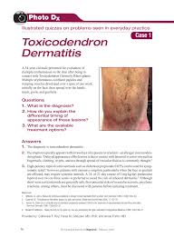 Image result for Rhus Dermatitis