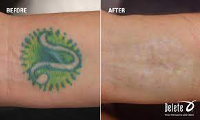 After all most of us would like to darker colors are easier to remove and may require fewer treatments. Before And After Dark Skin Color Tattoo Skin Color Tattoos Laser Tattoo Removal Tattoo Removal