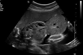 Fetal Abdomen And Abdominal Wall Anomalies Chapter 10 Fetal Medicine