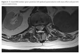 Image result for Spinal Epidural Abscess