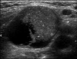 Ebenfalls nicht selten tritt die schilddrüsenverdickung bei autoimmunerkrankungen auf. Der Kalte Knoten Wie Haufig Ist Er Bosartig