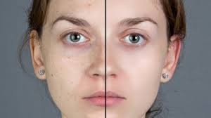 Vitamin e oil is rich in antioxidants that quickly absorb and help eliminate a blemish quite easily. Easiest Ways To Get Rid Of Facial Blemishes Yourbeautycraze Com