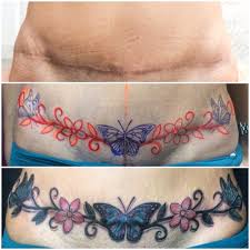 People try to cover them with clothing or some other means so they're not noticeable. The Most 23 Tattoos To Cover Tummy Tuck Scar Tumblr Tattoo Make Bauchdeckenstraffung Tattoo Tattoos Uberdecken Tattoo Bauch