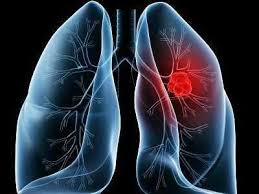 Since the mining days, the workers on the mining sites especially the ones with asbestos, suffered sooner or later from a form of cancer which is known as mesothelioma. 15 Cases Of Rare Cancer Detected A First In Rajasthan Times Of India