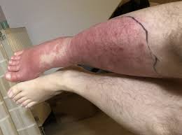 Image result for erysipel photos)