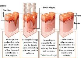 Microneedling Skinpen Infiniteskinfargo Light Therapy Skin Red Light Therapy Light Therapy