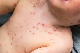 Penyebab cacar air adalah virus varicella zoster yang menyerang kulit penderita. Cacar Air Penyebab Gejala Dan Cara Mengobati