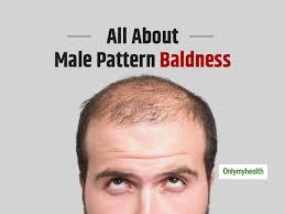 Patterned hair loss is the most common cause of hair loss seen in both the sexes after puberty. Male Pattern Baldness