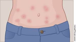 Symptoms include skin rash and joint pain. Erythema Multiforme For Parents Nemours Kidshealth
