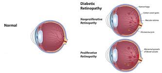 Diabetic Eye Care Milwaukee Diabetic Retinopathy Mequon