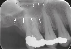 Image result for Maxillary Sinus