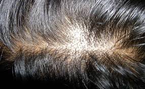 Scalp micropigmentation uses embedded dots of pigment to mimic the appearance of real hair follicles. Ø±Ø²Ø±Ùˆ ØªÙˆØ± ÙØ±ÙˆØ´ Ø¨Ù„ÛŒØ· Ù‡ÙˆØ§Ù¾ÛŒÙ…Ø§ Ø§Ø®Ø° ÙˆÛŒØ²Ø§ÛŒ Ø´Ù†Ú¯Ù† Ùˆ Ø¢Ø³ÛŒØ§ÛŒÛŒ