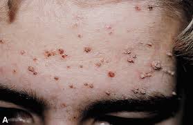 Image result for verrucae filiformes