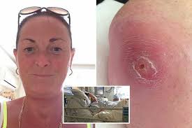 Mum almost died after tiny spot