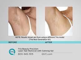 It's still expensive ($495), but it's based on the same technology as professional fractionated laser treatments: Tria Beauty Precision Laser Hair Removal For Face Beauty Qvc Com