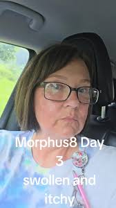 Morpheus 8 Recovery Day 3