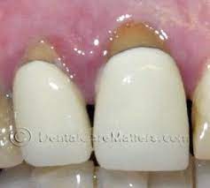 Gum Recession Around Crowns Receding Gums Gum Recession Gum Inflammation