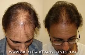 Best Hair Loss Treatment For Men And Women in Florida Hillsborough Harbor  Shores