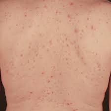 We did not find results for: Dermatitis Herpetiformis Altmeyers Encyclopedia Department Dermatology