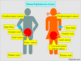 Image result for human papillomavirus symptoms