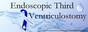 Endoscopic Third Ventriculostomy Etv Hydrocephalus Cerebrospinal Fluid Fluid Awareness