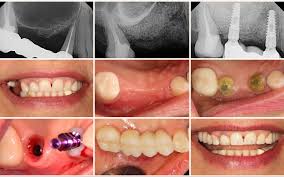 Smile Gallery Before And After Dental Cases By Dentist Glendale