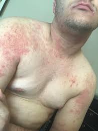 It can soothe dry, itchy skin resulting from eczema and help prevent infection. Do You Think This Is Eczema Or Hives I Can T Afford A Doctor And I M Having A Panic Attack I Don T Know What To Do From Here Eczema