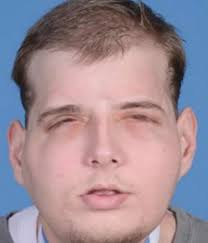 It's never felt so good to be ignored' says firefighter who had world's  most extensive face transplant