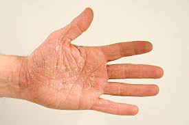 Image result for Hand Dermatitis