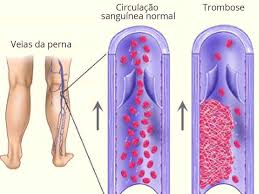 De gevolgen van trombose kunnen ernstig zijn. Quais As Dez Dicas De Ouro Na Prevencao Da Trombose Uai Saude