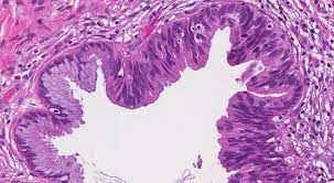 Carcinoma in situ stays in the cells where it started. Adenocarcinoma In Situ Ais Of The Cervix Mypathologyreport Ca