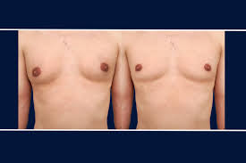 Image result for Gynecomastia