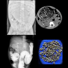 Image result for Necrotizing Enterocolitis