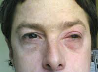 Auge Geschwollen Geschwollene Augen De