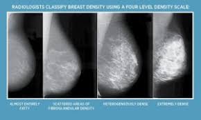 When this lesion develops in the breast tissues, they are referred to as breast lesions.breast lesions usually come in the form of lumps or swellings in or around the breast area, and. What S The Best Cancer Screening For Women With Dense Breasts Center For Diagnostic Imaging Cdi