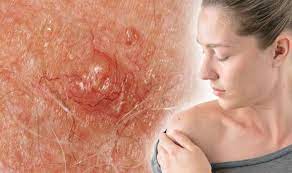 Here&#x27;s what to looks for: Skin Cancer Warning Itchy Spot Could Be Sign Other Than A Mole You Need To Watch Out For Express Co Uk