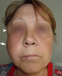 Image result for phlegmon on face)