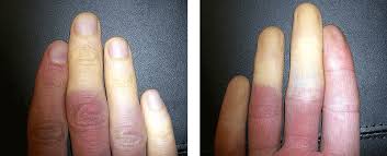 Raynaud Syndrom Univ Prof Dr Erich Minar