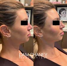 Bellafill is a long-lasting dermal filler designed to smooth wrinkles,  lift, and contour the face. Unlike temporary fillers, Bellafill is made of  tiny, smooth collagen beads that provide immediate volume and help