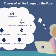 Milia typically clear up on their own, but if you'd like to speed up the healing process, here are seven remedies to help you get. What Is This White Bump On My Face